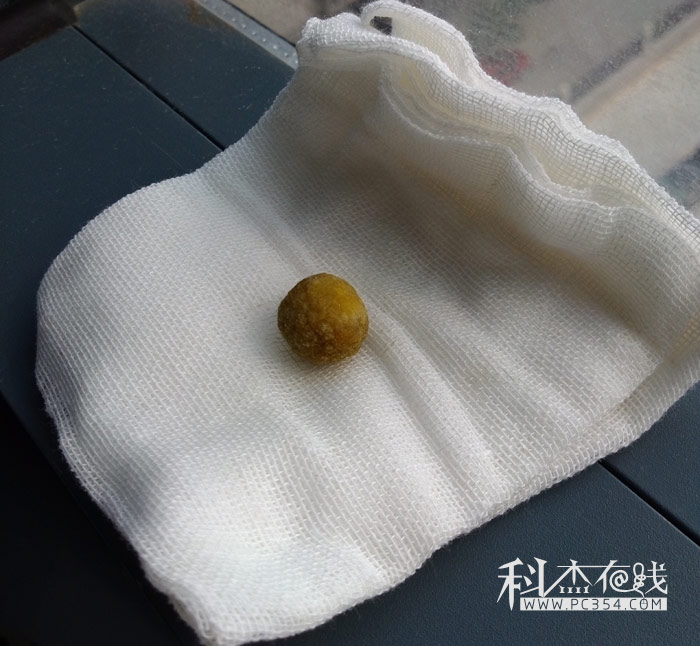 膽結(jié)石圖片